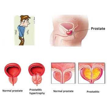 20 ks/Veľa ZB Prostatic Pupok Urológia Patch Urologických Prostaty, Bylinná Náplasť